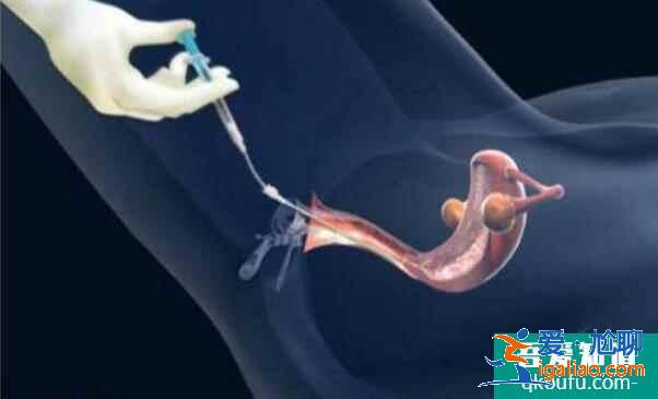 人工授精多次失敗后還可以做試管嬰兒嗎?? 人工授精多次失敗后還可以做試管嬰兒嗎??