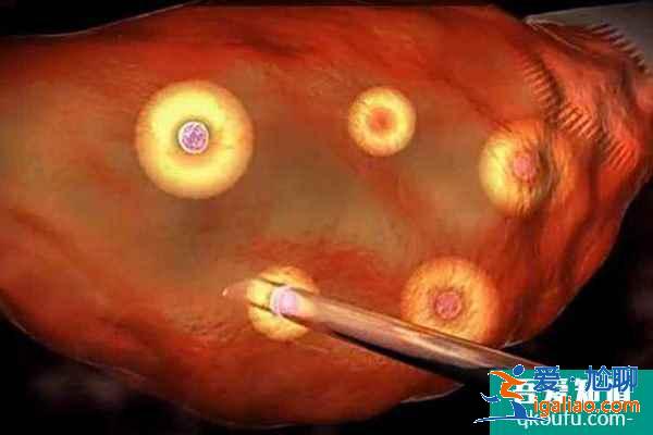 試管嬰兒專家解析：促排/取卵是否會導致腹腔積水？？