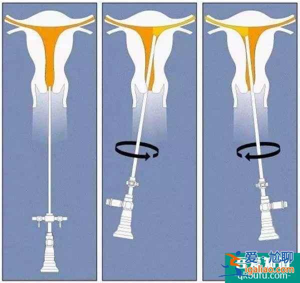 解惑：赴美做試管嬰兒還需要做宮腔鏡檢查嗎？？