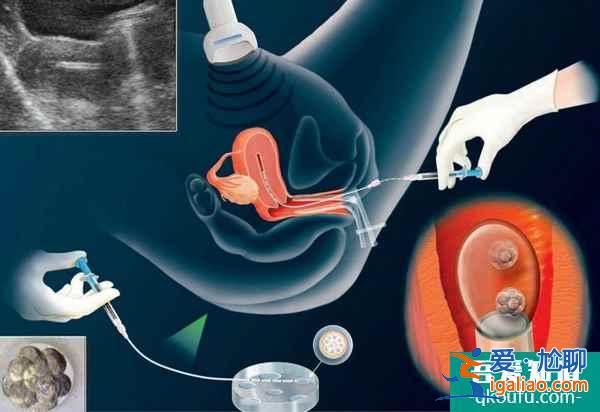 試管嬰兒:用一個試管周期成就一生求子心愿? 試管嬰兒:用一個試管周期成就一生求子心愿?