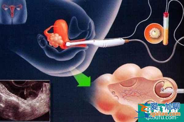 試管嬰兒為子宮腺肌癥患者保孕護航？