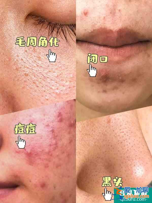 女明星的護膚方法解決了我的痘痘痘印問題！？