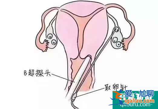 揭秘試管嬰兒取卵真相？