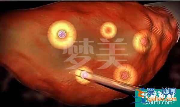 去做試管需要經歷哪些步驟?？