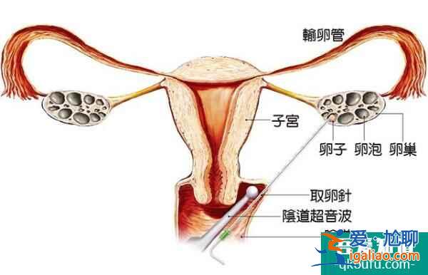 四類不孕女性的好孕錦囊—試管嬰兒？