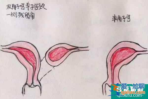 單角子宮對生育的影響？