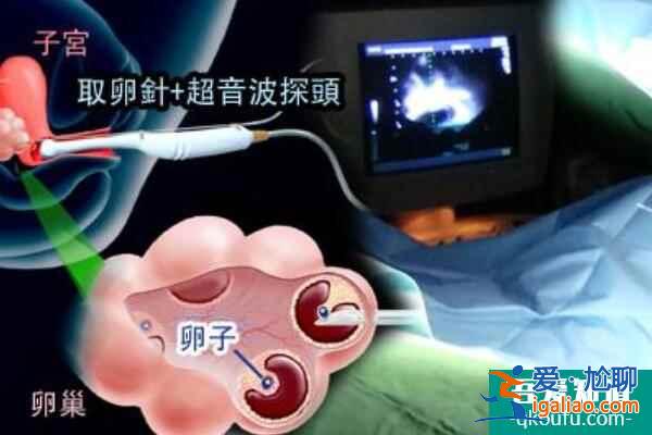 抗精子抗體對試管嬰兒有沒有影響？？