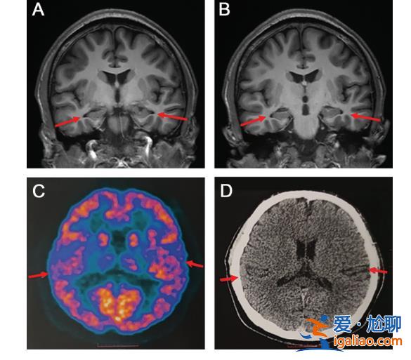 19歲男生患阿爾茲海默癥 研究參與者曾不相信檢查結果？