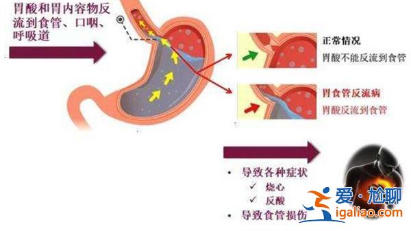 患胃食管反流17年，男子接受手術后終于能“躺平”獲新生[手術治療]？