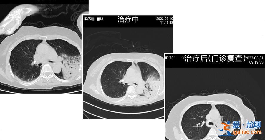 上海77歲阿婆感染“鸚鵡熱”呼吸衰竭 多家醫院收到類似病例？