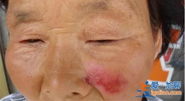女子旅游后高燒不退確診不死癌癥，多發年輕女性[高燒不退]？