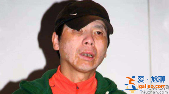 馮小剛白癜風(fēng)病怎么治好的?本人稱沒(méi)吃任何藥