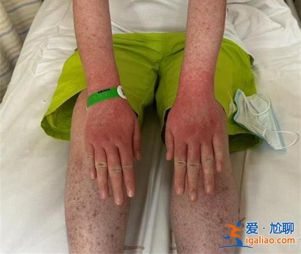 杭州女子養倉鼠臉爛成火龍果，竟是羌蟲病惹的禍[養倉鼠]？