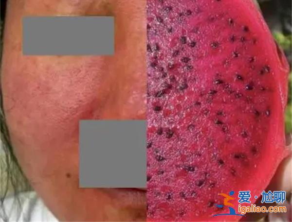 杭州女子養倉鼠臉爛成火龍果，為何會爛臉[何會爛臉]？