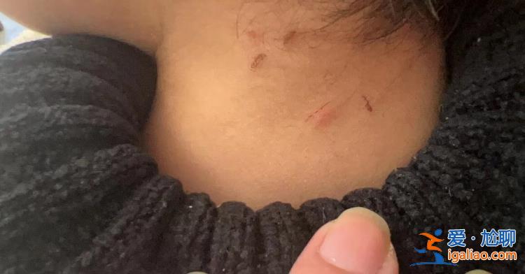 浙江溫州家長稱3歲孩子遭全托老師虐待 從頭到腳都是摳痕 警方回應? 浙江溫州家長稱3歲孩子遭全托老師虐待 從頭到腳都是摳痕 警方回應?