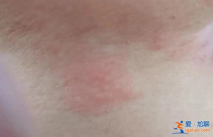 帶狀皰疹一次中招終身免疫？真實(shí)答案是這樣的？