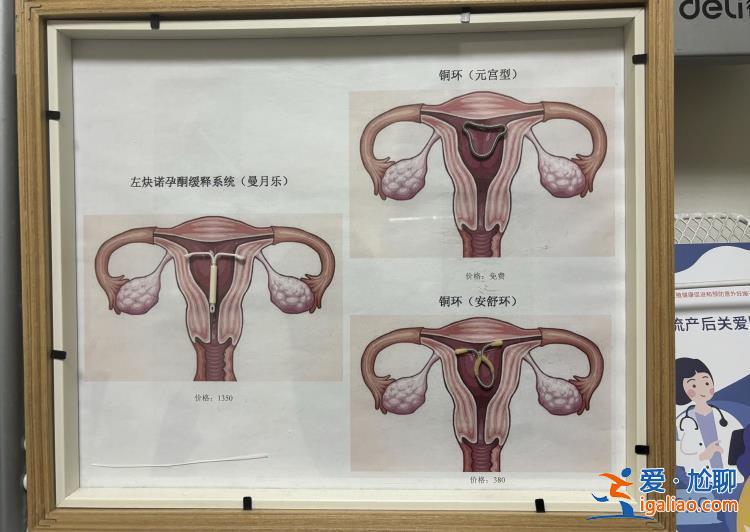 54歲的媽媽 “28歲”的節育環？
